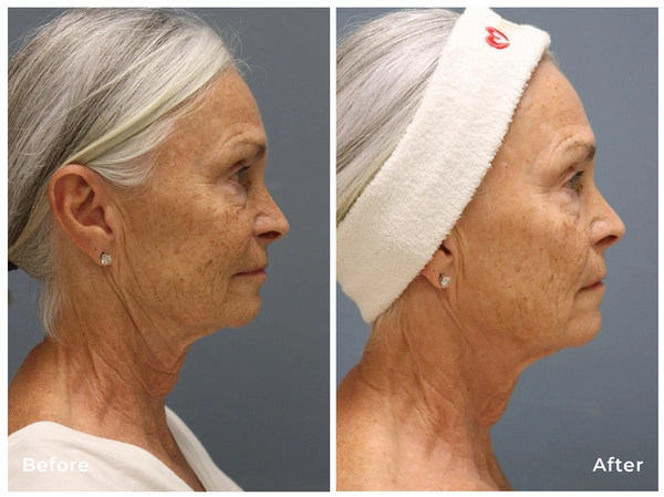 RF_Microneedling_Pixel8_before_after_03v2