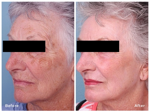 Laser resurfacing before and after results