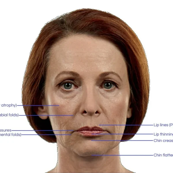Areas of contour and volume loss on face