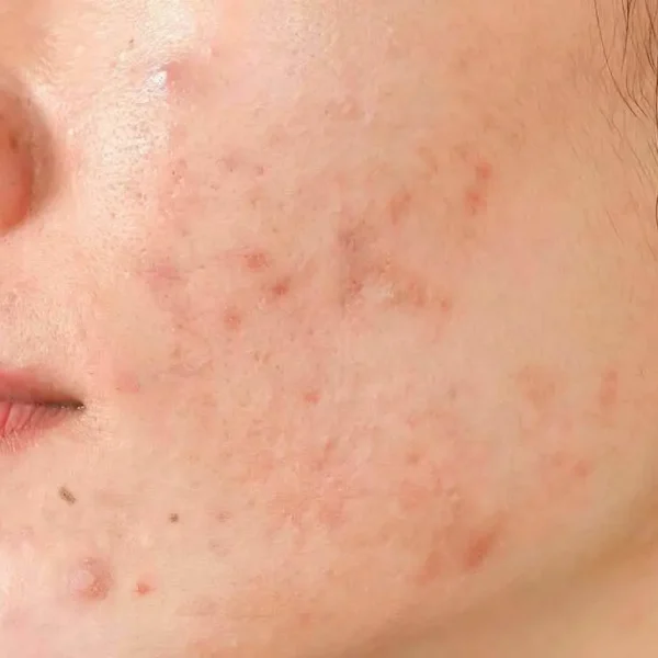 Acne scar - raised due to excess collagen during healing