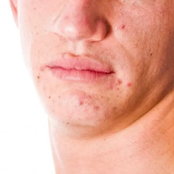 Acne and acne scar on chin