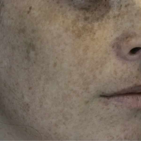 dark freckles