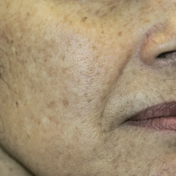 Mottled pigmentation on face