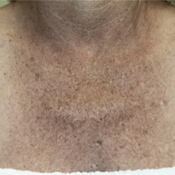 Mottled pigmentation on chest