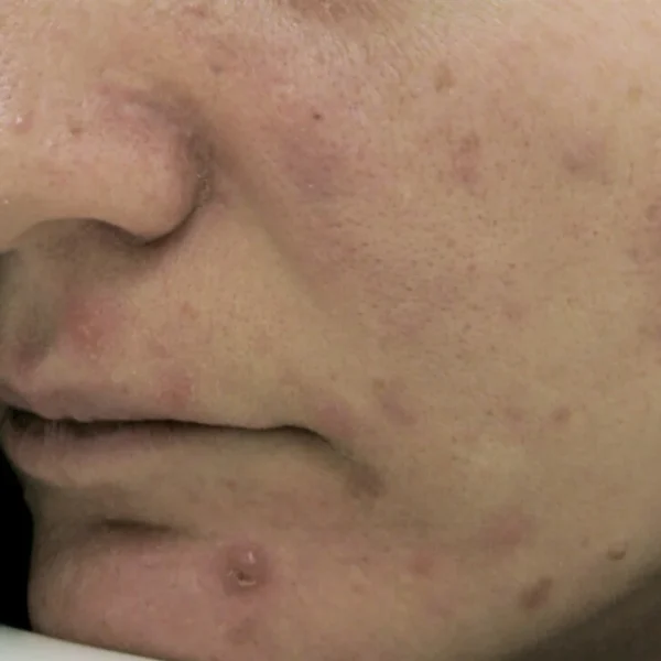 Acne  and its scars on chin and cheek