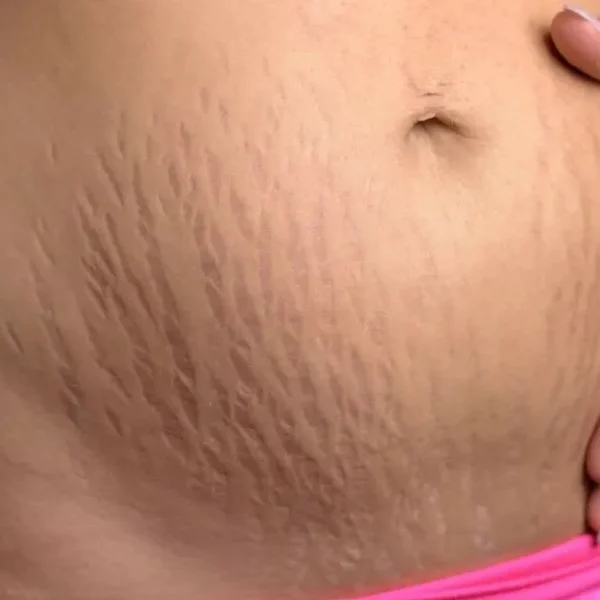Stretch marks on abdomen area resulting from pregnancy