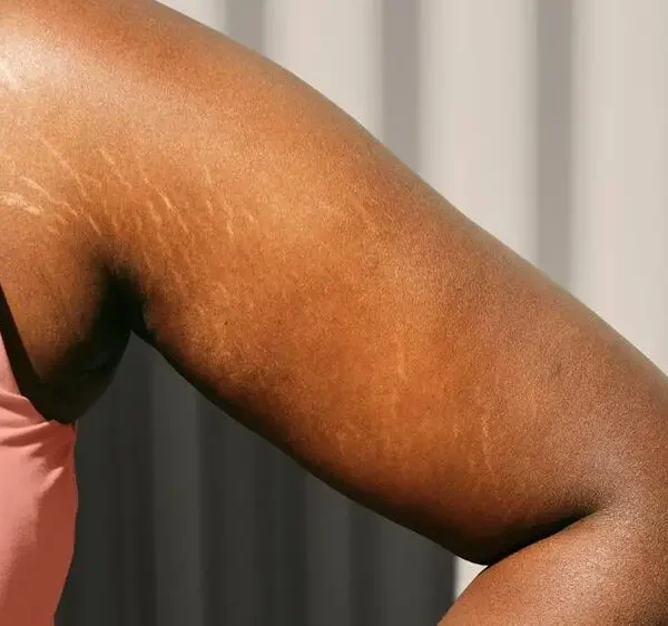 Stretch marks on upper arms/outer chest resulting from weigh gain followed by weight loss