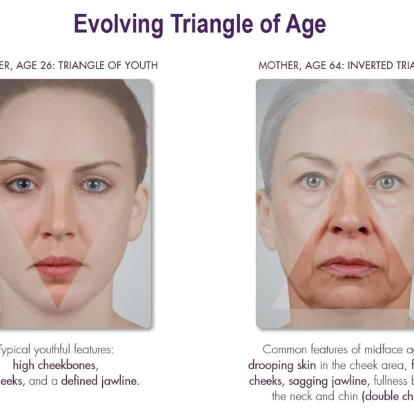 Holistic Elegance dermal (lip) fillers, facial triangle of age
